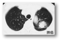 クレモト外科 肺癌写真例