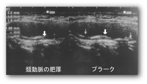 クレモト外科　頚動脈の肥厚とプラーク写真例