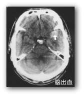 クレモト外科　脳出血写真例